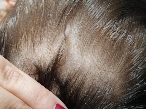 Jak rozpoznat hnidy na suché pokožce syna?