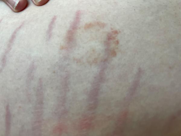 Alergie nebo kopřivka?