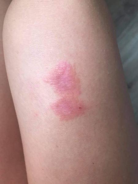 Kožní problém. Co to může být? Mizí to?