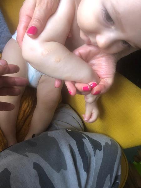 Vyrážka u ročního miminka. Co by to mohlo být?