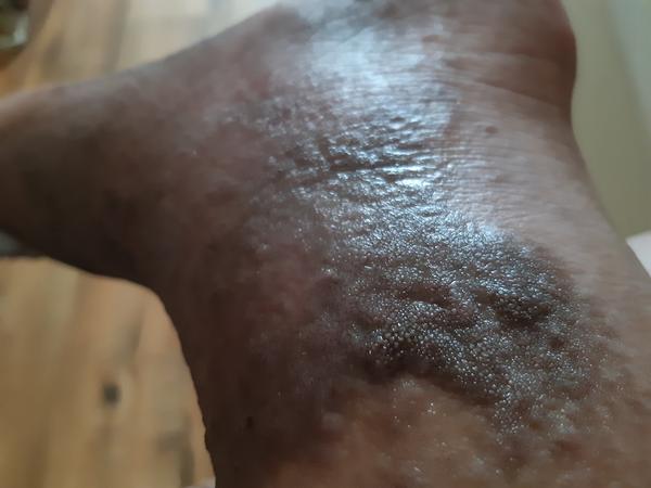 Vřídky nebo vyrážka?