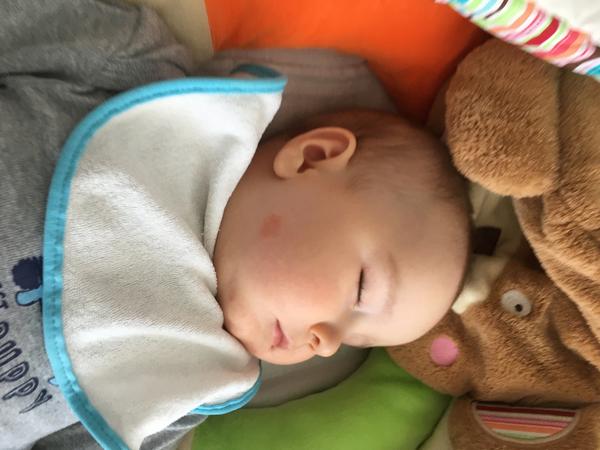 Ekzém na tváři-kojenec 7 měsíců. Poradíte, prosím?