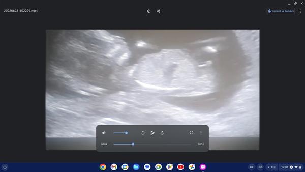 Pohlavní hrbolek ve 14. týdnu: Je to chlapeček?