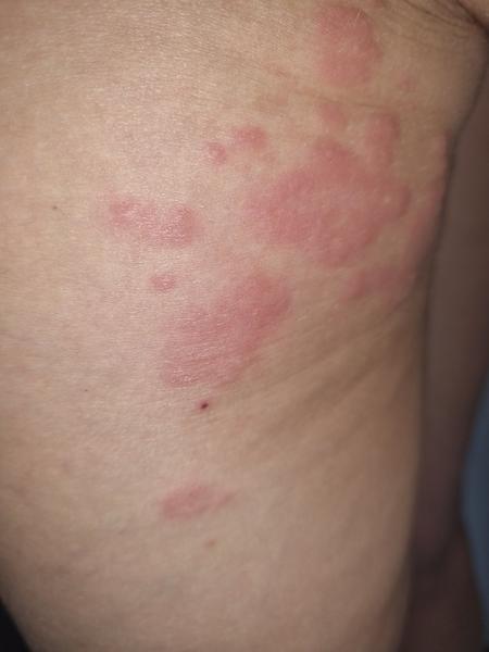 Kožní vyrážka po dovolené v Tunisku. Jak postupovat?