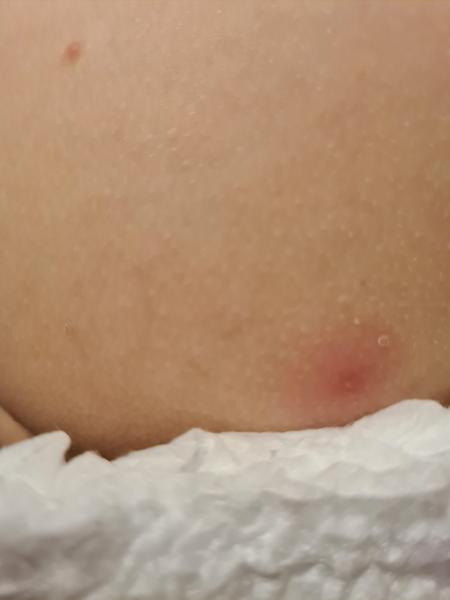 Co by to mohlo být za vyrážku?