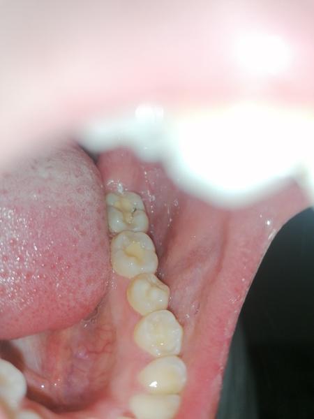 Kaz na zubu, i když jsem byla na kontrole. Je možné, že to pan doktor neviděl?