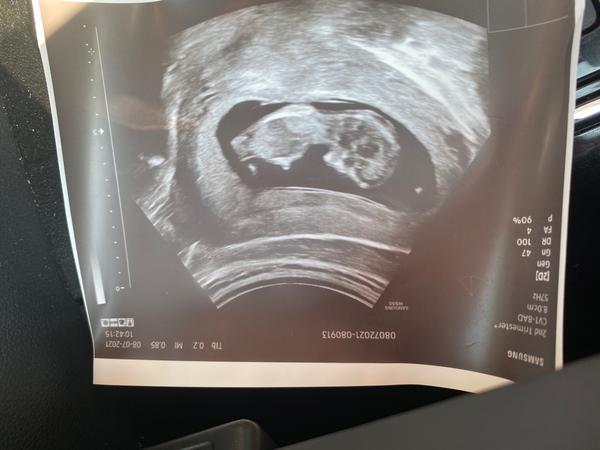 Chlapeček či holčička?