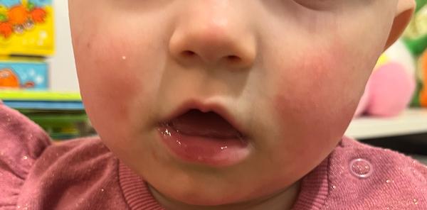 Červená vyrážka na tvářích u dětí. Jak řešit problém?