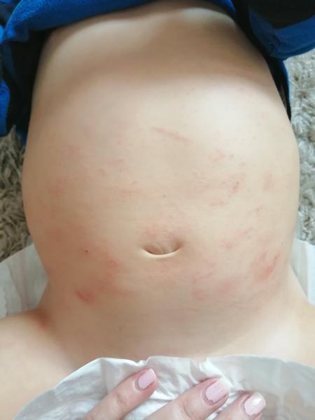 Co to může být, ekzém?