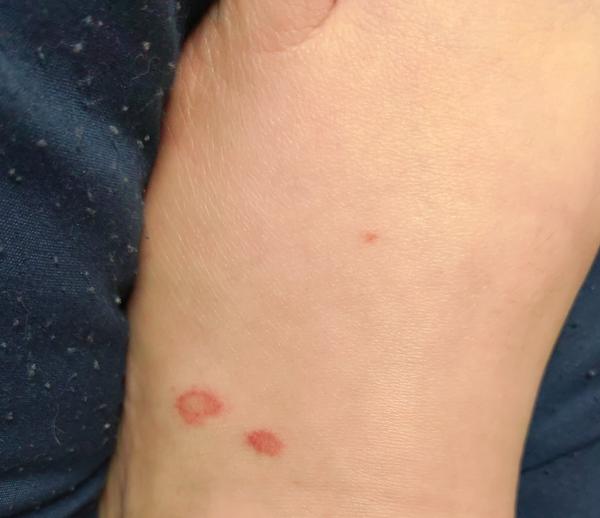 Jak zjistit původ vyrážky, která nesvědí?