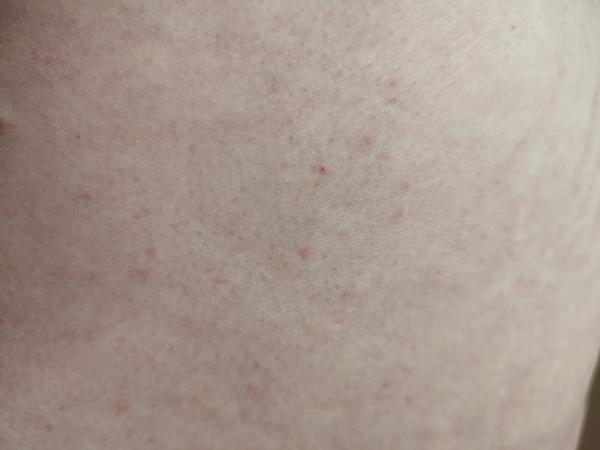 Co způsobuje vyrážku na stehnech a břichu?