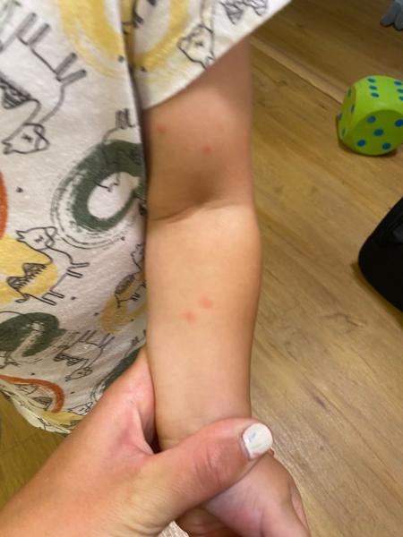 Jak léčit štípance od sametky či svilušky u dětí?