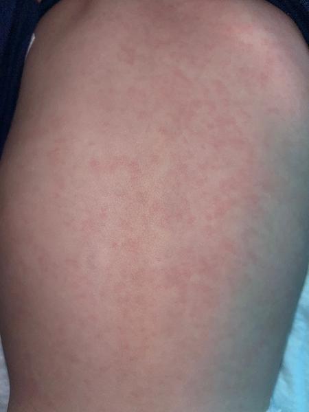 Vyrážka po střevní viróze u batolete. Máte zkušenost?