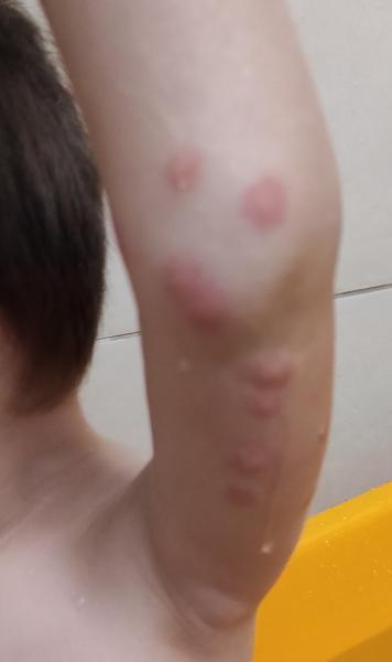 Co dělá takové štípance?