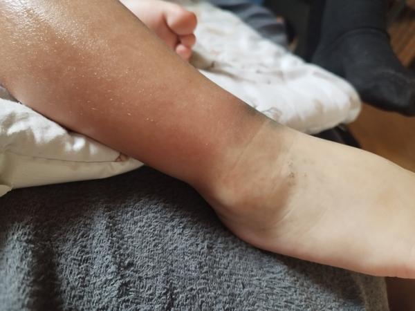 Podráždění batolecí pokožky vločkovacími tabletami. Máte zkušenost?