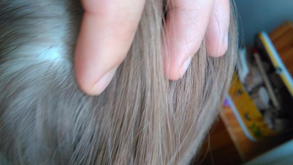 Holé místo ve vlasech u 7leté dcery