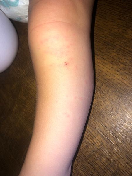 Vyrážka na kolenou a loktech dítěte po návratu z Tuniska?