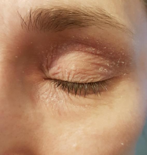 Ekzém a šupinatění očí. Poradíte, prosím?