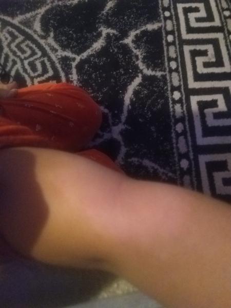 Ekzém a stálé svědění. Co na to?