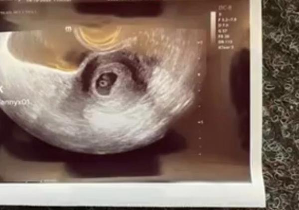 Odpovídá termín těhotenství datům poslední menstruace?