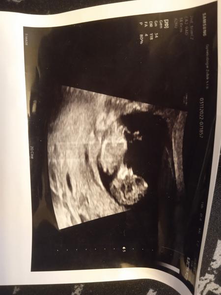 Chlapeček nebo holčička?