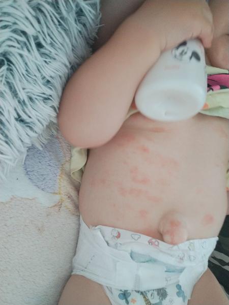 Vyrážka u dítěte na břiše: co pomáhá?