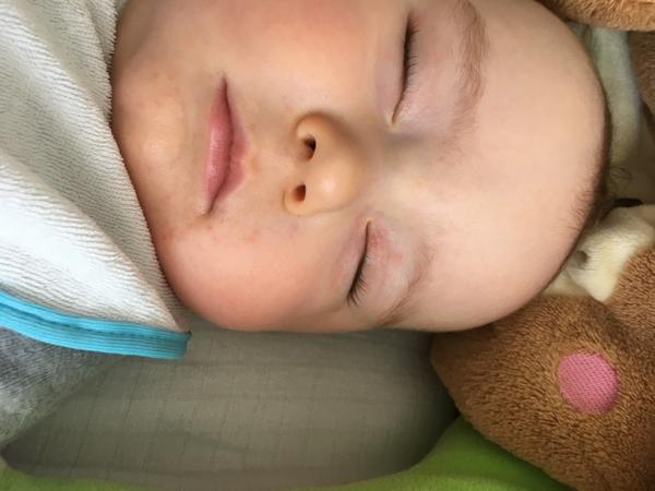 Ekzém na tváři-kojenec 7 měsíců. Poradíte, prosím?