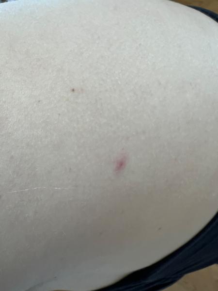 Mohou být pupínky příznakem neštovic během těhotenství?