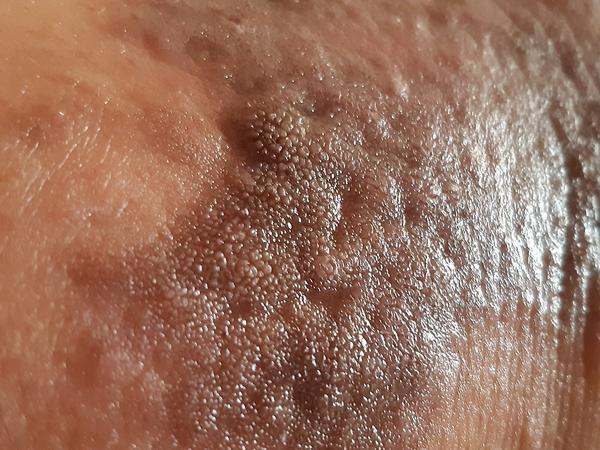 Vřídky nebo vyrážka?