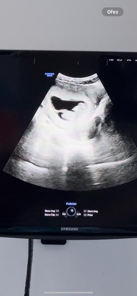 Pohlaví dítěte. Lze určit?