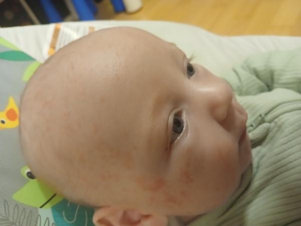 Seborea / novorozenecké akné / ABKM. Co by to mohlo být?