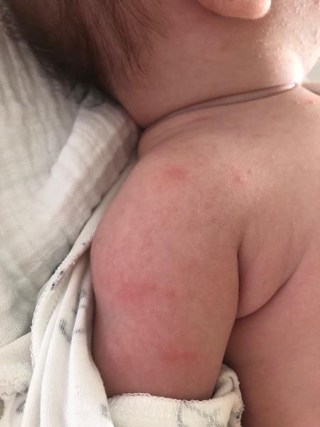 Vyrážka v obličeji a na rukách. Co byste poradila?