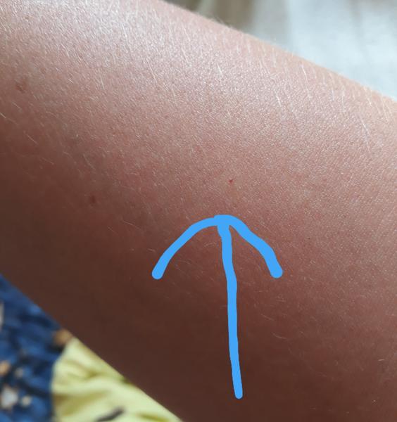 Červené tečky na pažích - angiomy. Má je někdo taky?