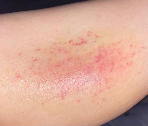 Svědivá vyrážka na lýtku. Je důvod k obavám?