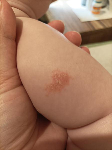 Ekzém, nebo něco jiného?