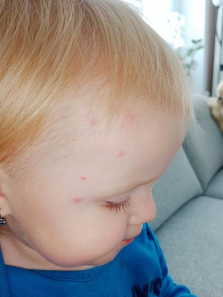 Pupínky. Je možné, že jsou to neštovice?