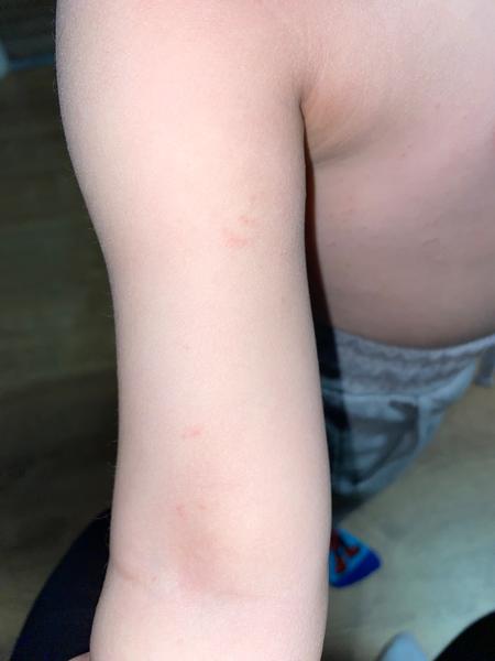 Vyrážka u tříletého dítěte. Jak to řešit?