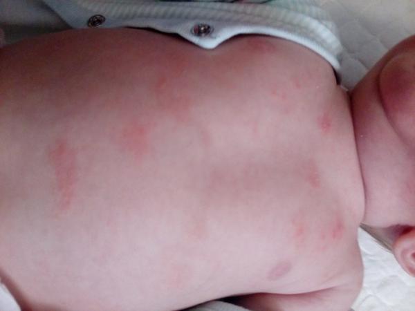 Ekzém u 4měsíčního miminka. Poradíte, prosím?
