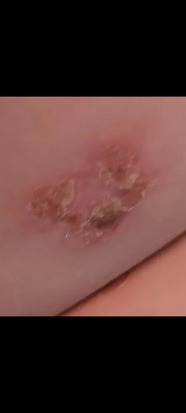 Infekce kůže bez zlepšení. Je nutná pohotovostní návštěva?