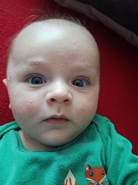 Akné ve 4 měsících?