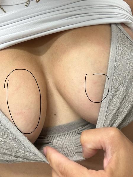 Červené fleky na prsou. Je třeba navštívit lékaře?