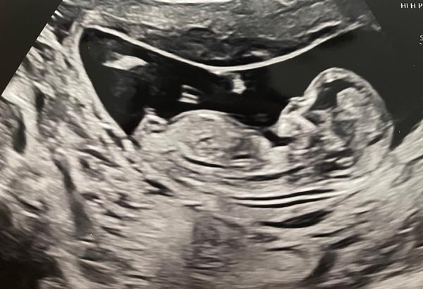 Máte tip na pohlaví z fotek lékařského ultrazvuku?