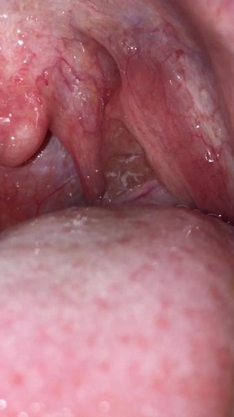 Je moučnivka příčinou bílých skvrn v ústech?