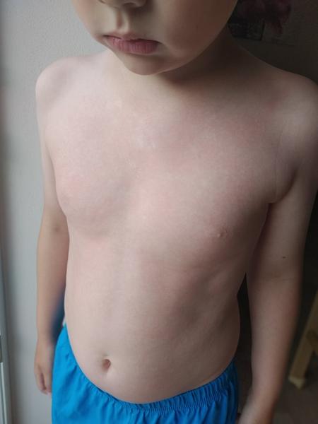 Vyrážka u dítěte: Co ji může způsobit?