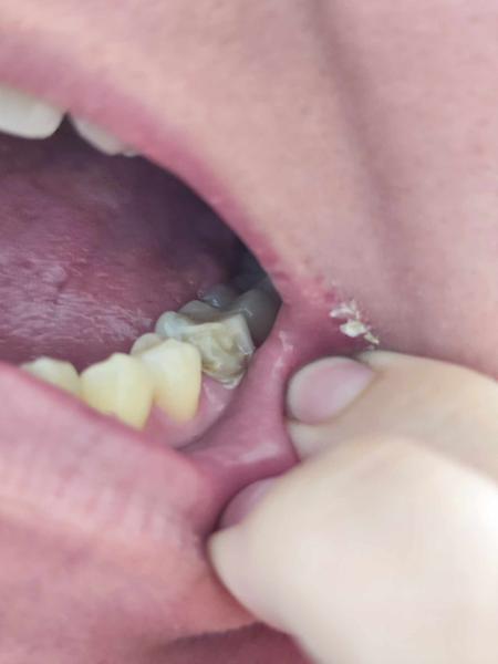 Ulomený zub. Lze ho ještě zachránit, když nebolí?