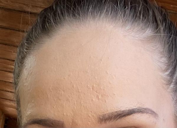 Jak se zbavit krupičky na čele po porodu?