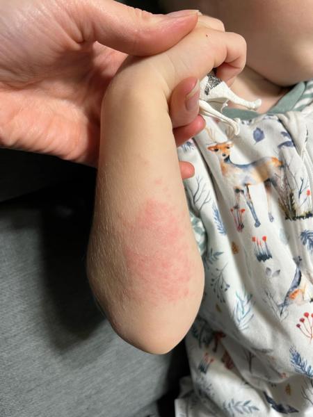 Rada při vyrážce u dítěte. Jaké masti použít?