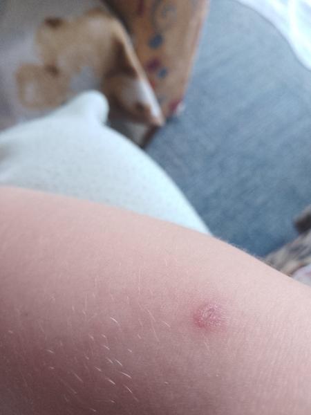 Vyrážka na ruce. Co by to mohlo být?