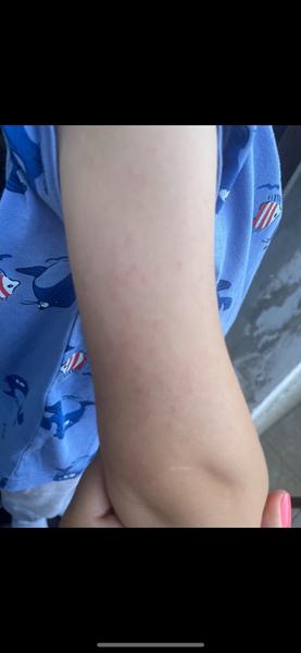 Máte zkušenosti s červenými uši, tvářemi a vyrážkou?