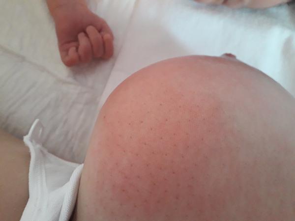 Červená "vyrážka" na prsu - není ale ani tvrdé, ani teplé